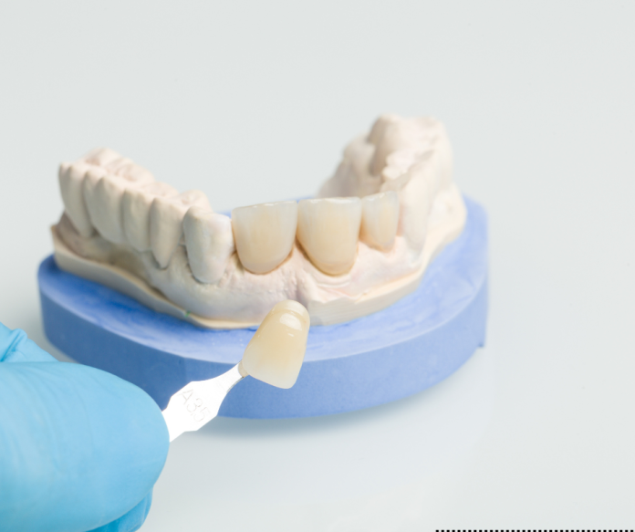 Untitled design dental veneers