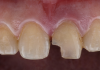 What Is Dental Bonding and When Is It an Appropriate Treatment? chipped tooth