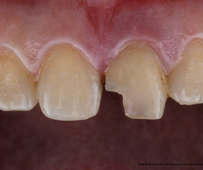 chipped tooth chipped tooth