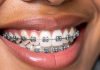 Learn How Orthodontic Issues Can Potentially Contribute to Chronic Headaches or TMJ Pain braces