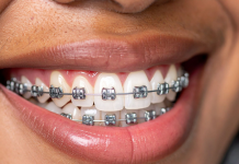 Learn How Orthodontic Issues Can Potentially Contribute to Chronic Headaches or TMJ Pain braces