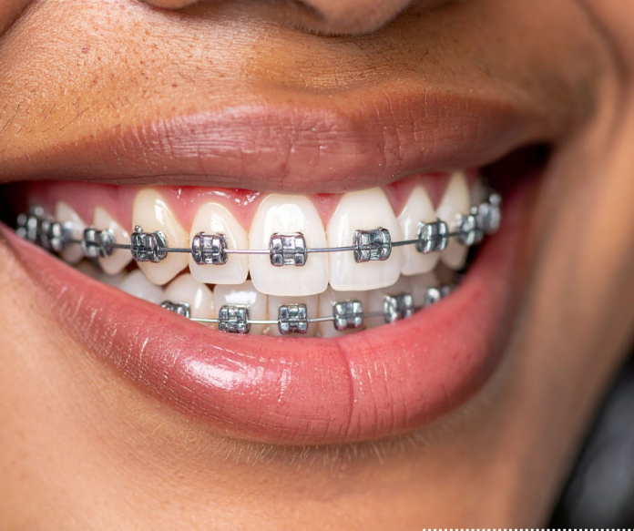 braces