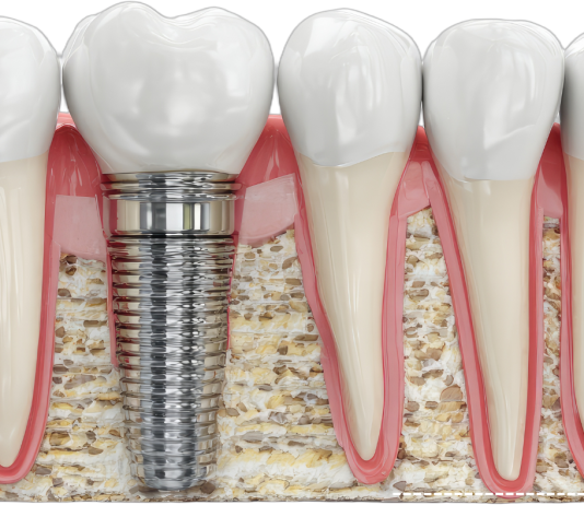 Can I Still Get Dental Implants If I Have Bone Loss? dental implant
