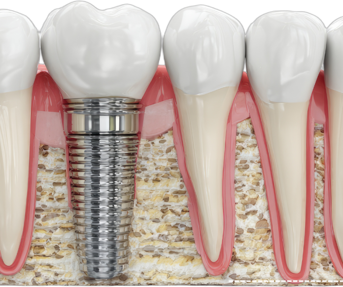 Untitled design (2) dental implant
