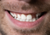 Should I Replace a Missing Tooth? missing tooth