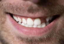 Should I Replace a Missing Tooth? missing tooth