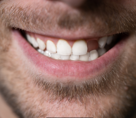 Should I Replace a Missing Tooth? missing tooth