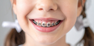 When Should My Child Start Orthodontic Treatment? children orthodontics