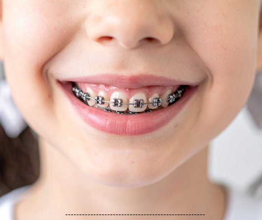 When Should My Child Start Orthodontic Treatment? children orthodontics