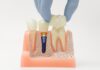 What Is the Lifespan of My Dental Restoration? dental restorations
