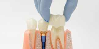 What Is the Lifespan of My Dental Restoration? dental restorations