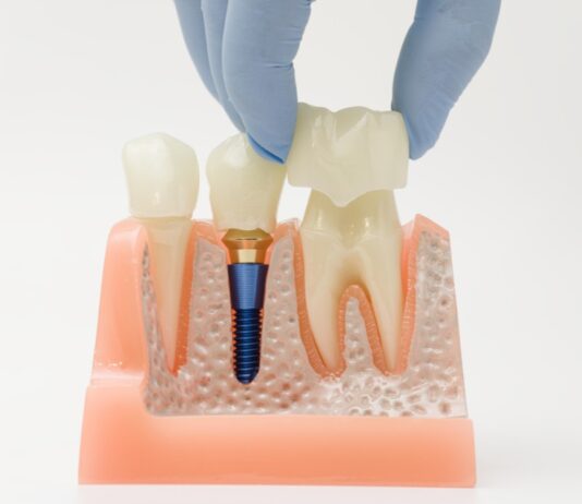 What Is the Lifespan of My Dental Restoration? dental restorations