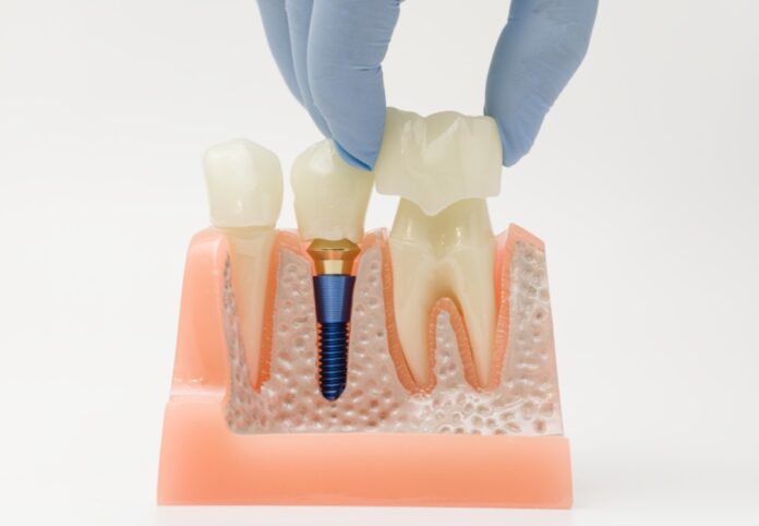 dental restoration dental restorations