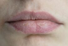 Don’t Ignore a Dry Mouth dry mouth