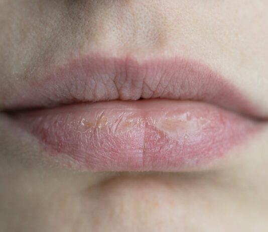 Don’t Ignore a Dry Mouth dry mouth