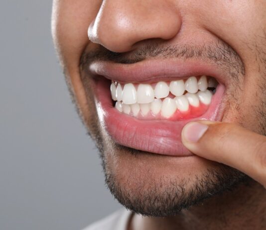 Hidden Ways That Anxiety Can Affect Your Teeth and Gum Health gum health
