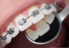 What Happens During an Orthodontic Consultation? orthodontics
