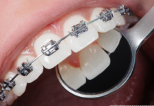 What Happens During an Orthodontic Consultation? orthodontics