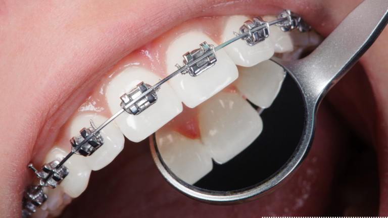 What Happens During an Orthodontic Consultation? What Happens During an Orthodontic Consultation?