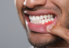 Why Do Teeth Shift Over Time (Even Without Braces)? gum disease