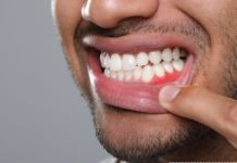 Why Do Teeth Shift Over Time (Even Without Braces)? gum disease