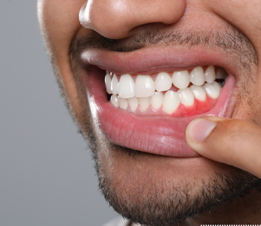 Why Do Teeth Shift Over Time (Even Without Braces)? gum disease