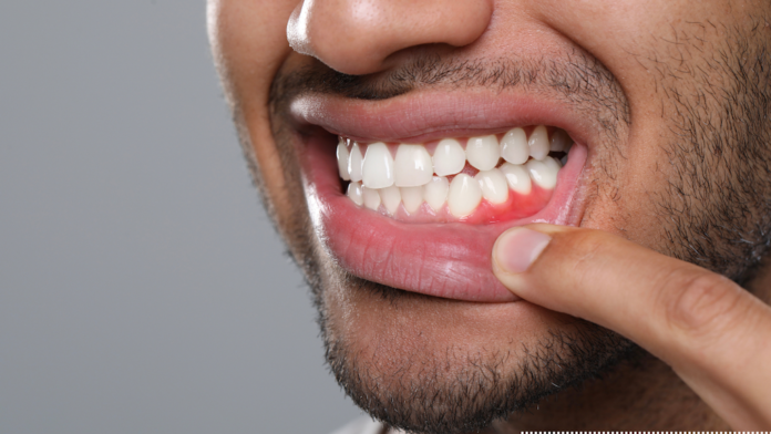 Untitled design (5) gum disease