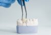 5 Reasons You May Need a Dental Crown dental crown lansdowne va