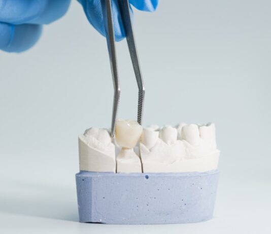 5 Reasons You May Need a Dental Crown dental crown lansdowne va