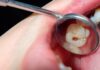 What Happens If a Cavity Goes Untreated? cavity tooth decay dental health