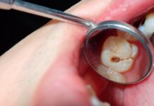 What Happens If a Cavity Goes Untreated? cavity tooth decay dental health