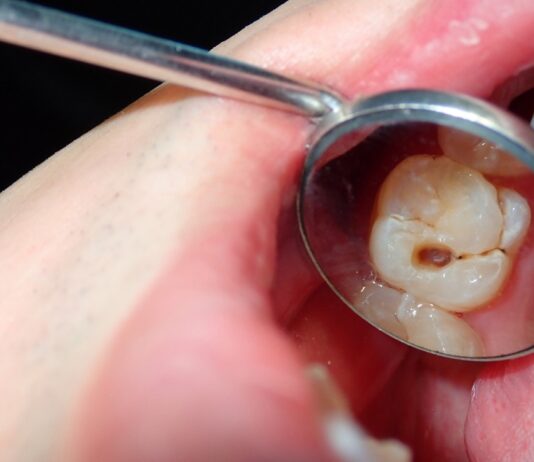 What Happens If a Cavity Goes Untreated? cavity tooth decay dental health