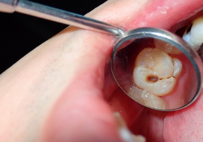 cavity tooth decay dental health