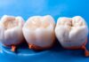 Why Do Fillings Fail Over Time? dental filling