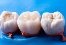 Why Do Fillings Fail Over Time? dental filling