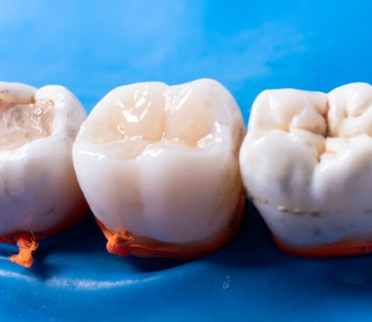 Why Do Fillings Fail Over Time? dental filling