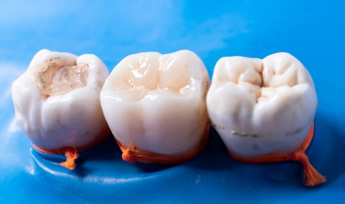 dental filling
