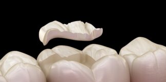 What Is a Dental Inlay or Onlay? dental inlay onlay