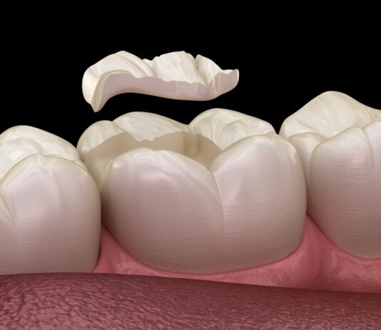 What Is a Dental Inlay or Onlay? dental inlay onlay