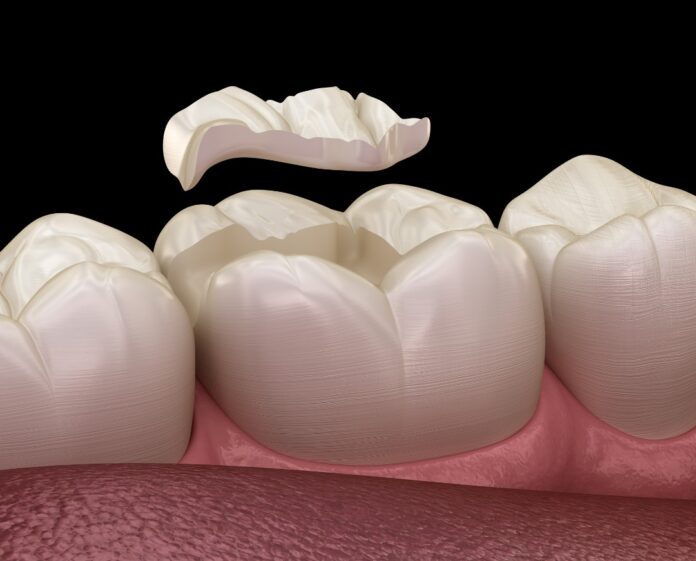 dental inlay onlay