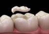 What Happens If a Filling Falls Out? tooth filling aldie va
