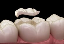 What Happens If a Filling Falls Out? tooth filling aldie va