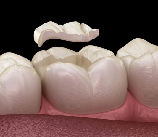 What Happens If a Filling Falls Out? tooth filling aldie va