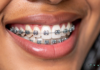 The Role of Rubber Bands in Braces braces