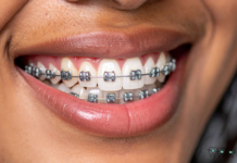 The Role of Rubber Bands in Braces braces