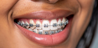 The Role of Rubber Bands in Braces braces