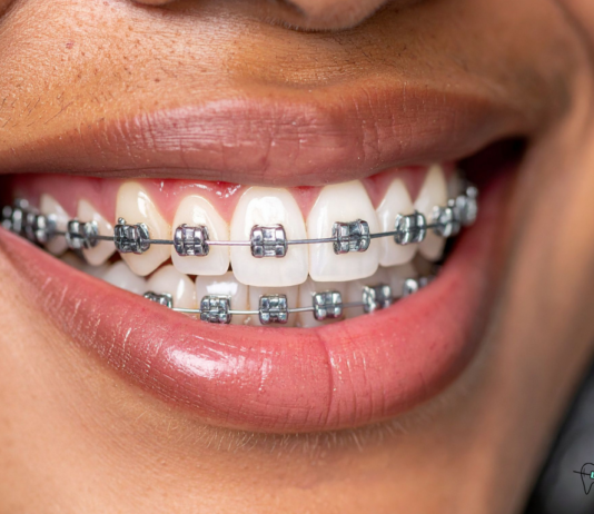 The Role of Rubber Bands in Braces braces
