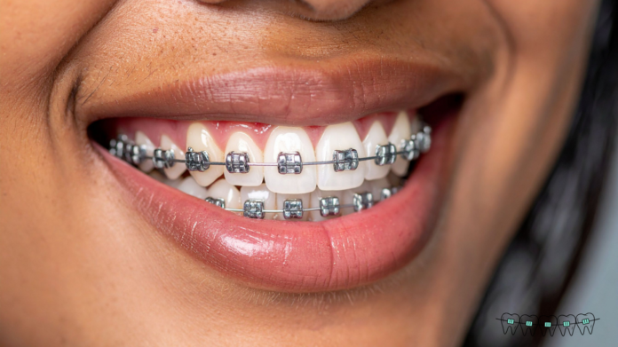 braces braces