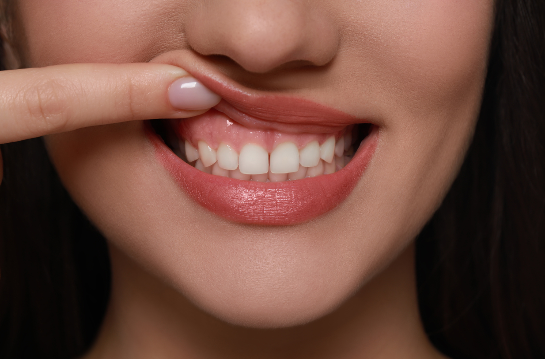 Can Cosmetic Dentistry Fix Uneven Gum Lines?
