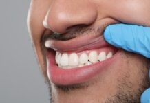 What Causes Receding Gums? receding gums